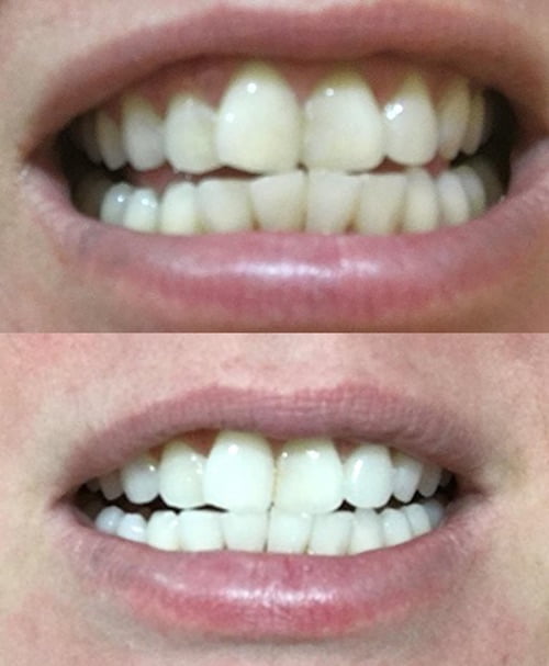 boggieboardcottage: Crest 3d White Strips Professional ...